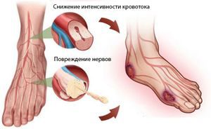 поврежденные нервы на ногах
